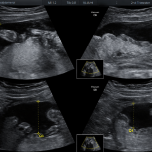 eco de perfil biofísico fetal
