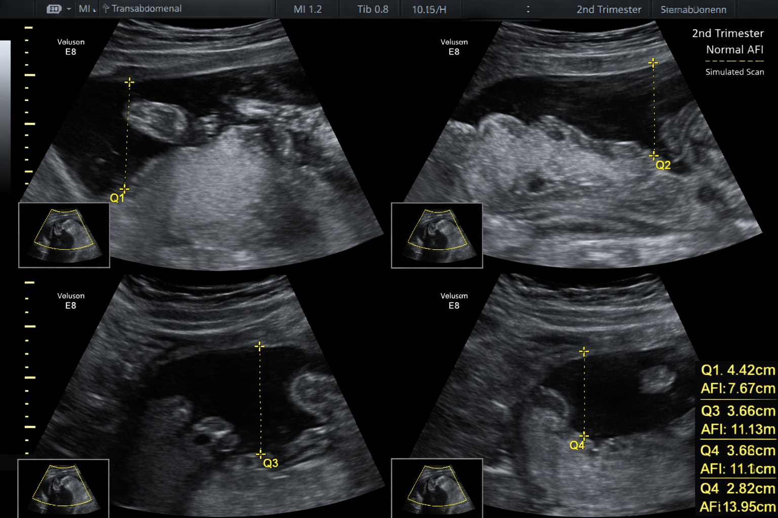 Obstetricia eco de perfil biofísico fetal